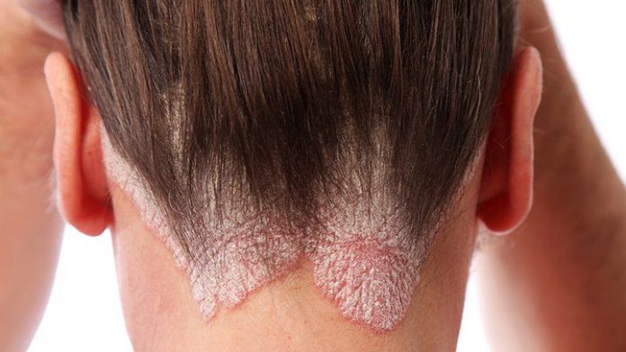 Scalp Psoriasis Treatment