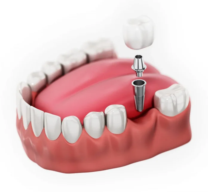 Dental Implant