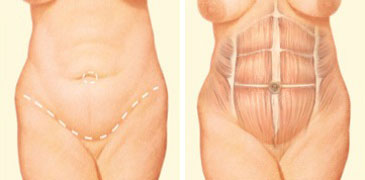 Tummy Tuck